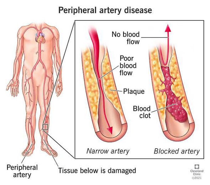 Peripheral Artery disease