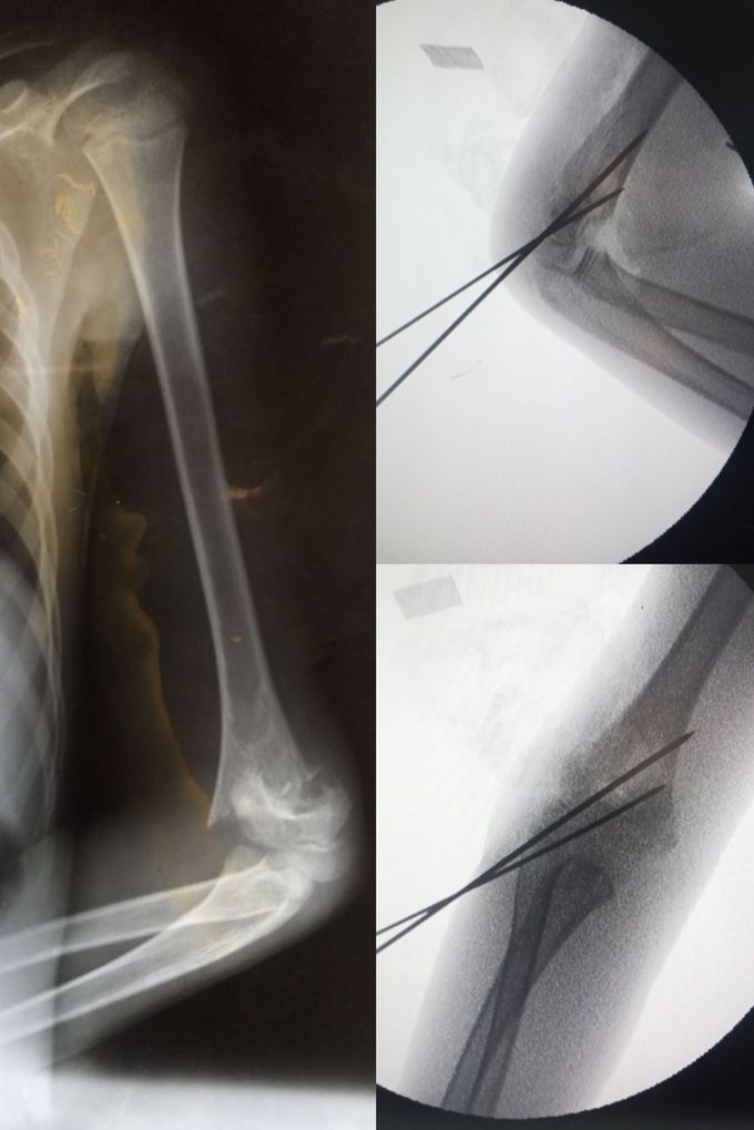 Supracondylar Fx of humerus
