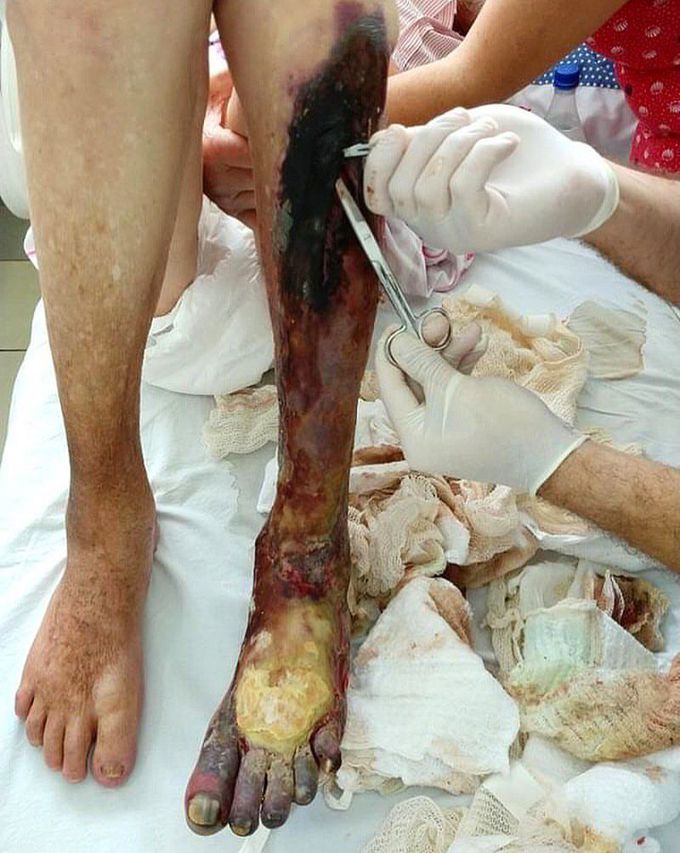 Chronic arterial thrombosis of the lower extremity!! 