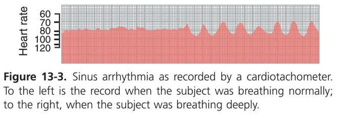 Sinus arrhythmia