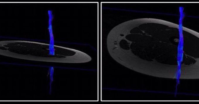 Diffusion Tensor Imaging (DTI) of the left calf