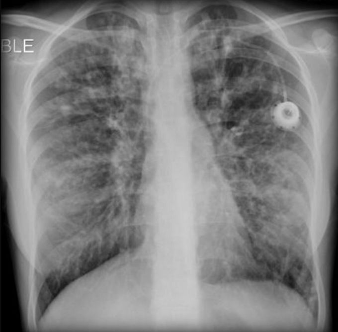 Cystic fibrosis (pulmonary manifestations)