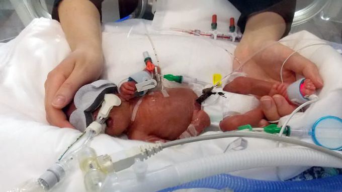 EXTREMELY PREMATURE BABY BORN AT 24 WEEKS
