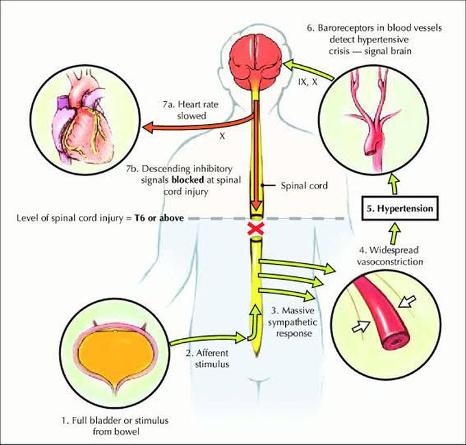 Autonomic dysreflexia