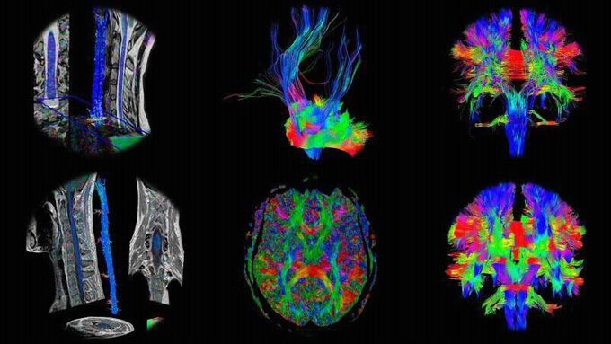Diffusion Tensor Imaging (DTI) acquired from different Siemens scanners!