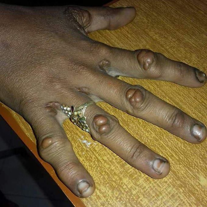 What is yoir Diagnosis?