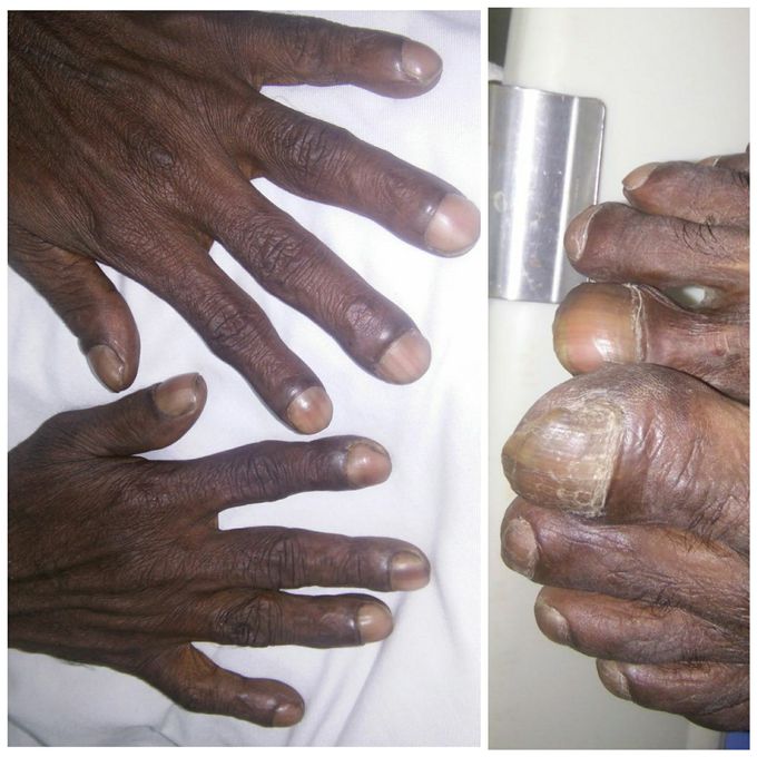 Case of cubbing