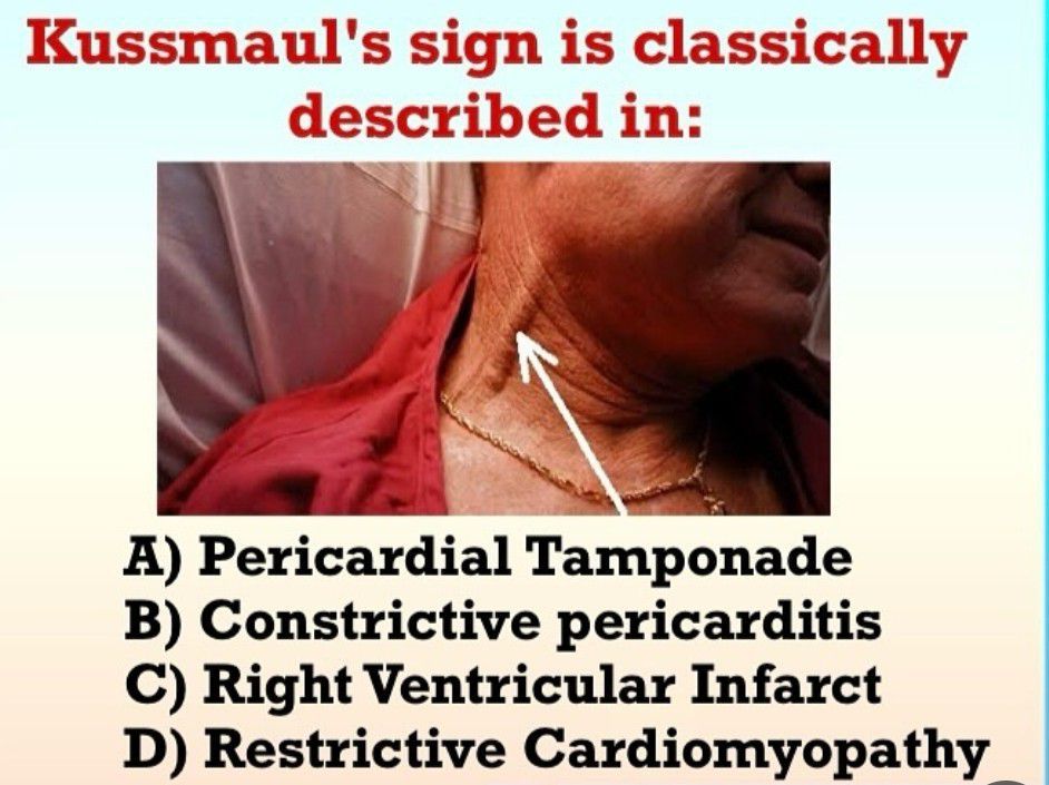 Kussmaul Sign - MEDizzy