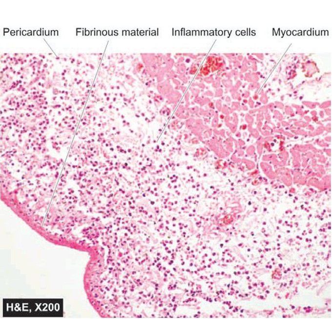 Fibrinopurulent pericarditis.