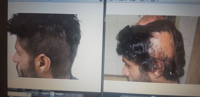Skin burns and hair transplant