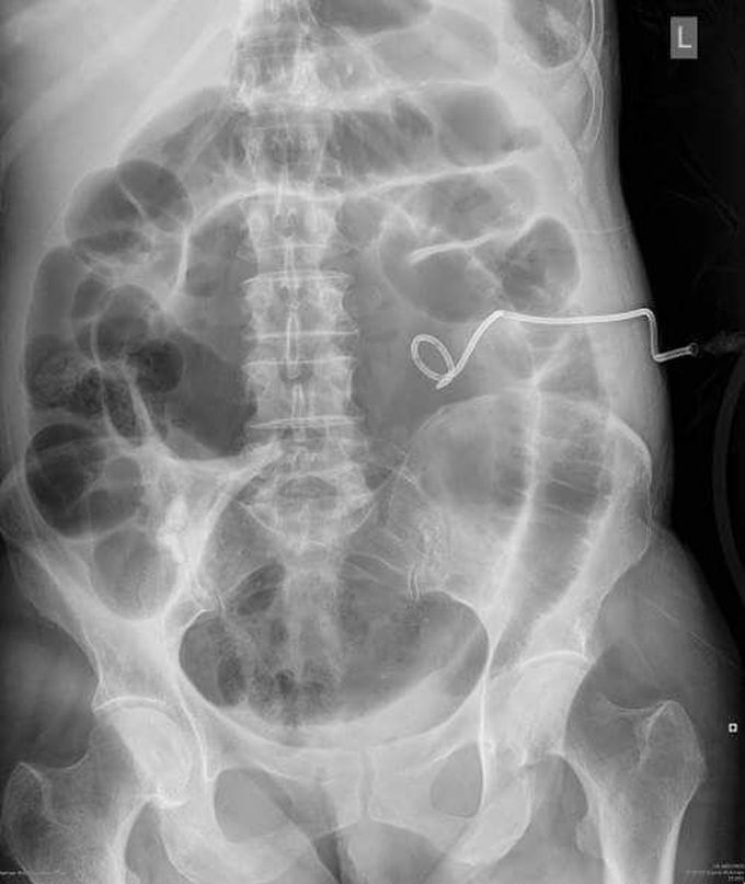 Interesting abdomen film ☢️