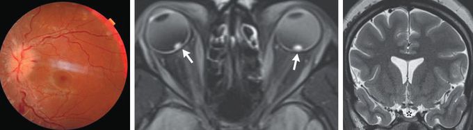 Idiopathic Intracranial Hypertension