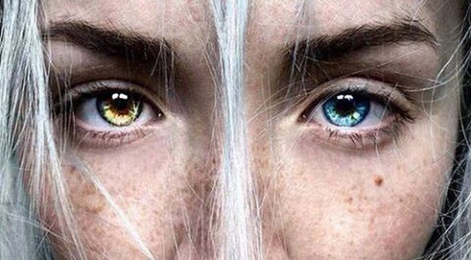 Heterochromia