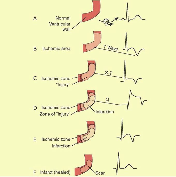 ECG wave changes during evolution of myocardial damage