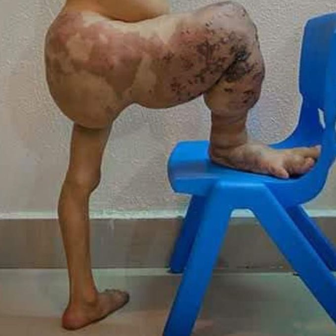 Klippel-Trenaunay syndrome (KTS)