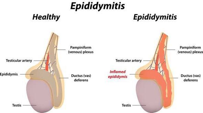 Epididymitis