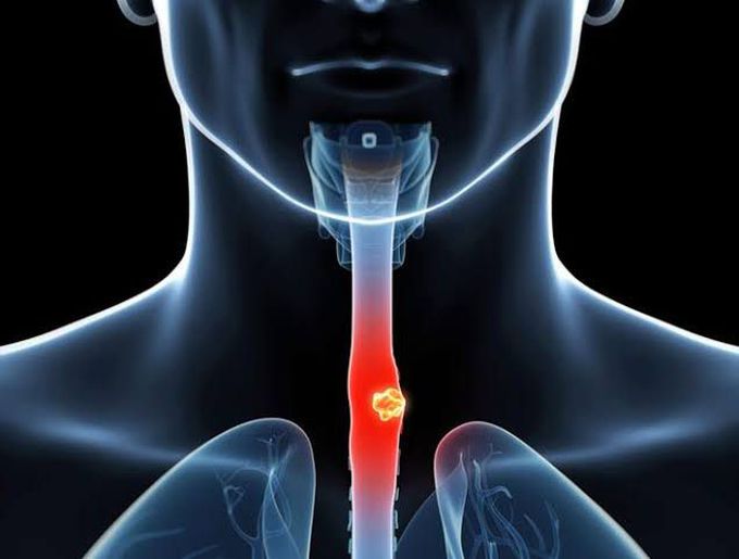 Treatments of esophageal cancer