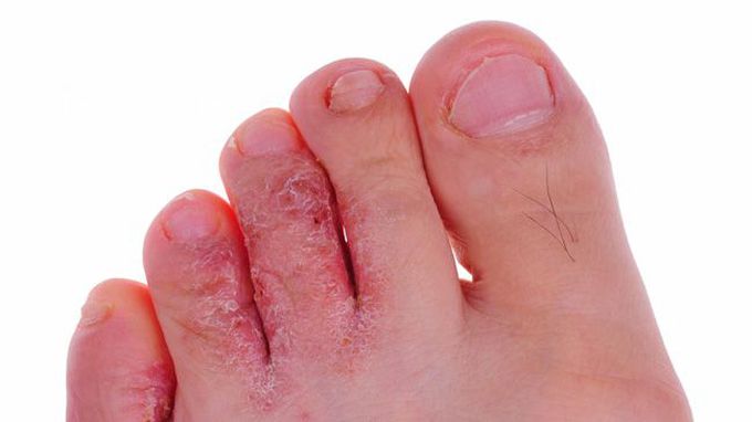 Symptoms of Athlete's foot