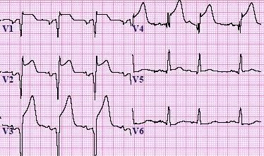 ECG changes in acute MI - MEDizzy