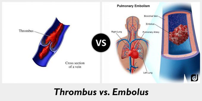 Thrombosis vs embolism