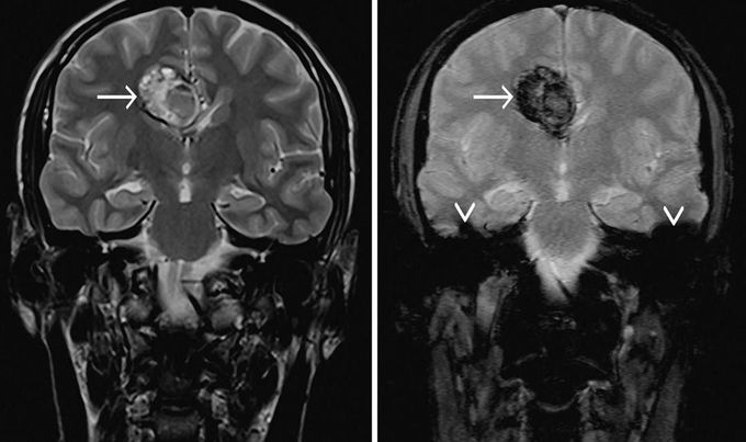 Cerebral cavernous venous malformations MRI