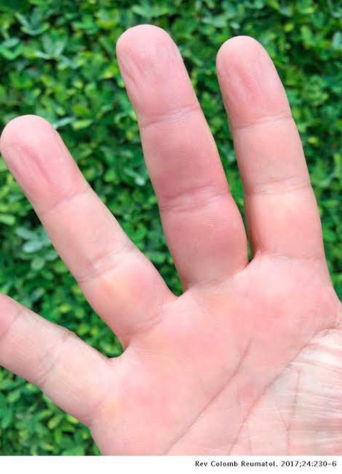 causes of achenbach syndrome