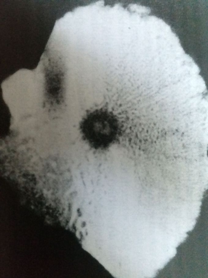 Intracortical osteoid osteoma