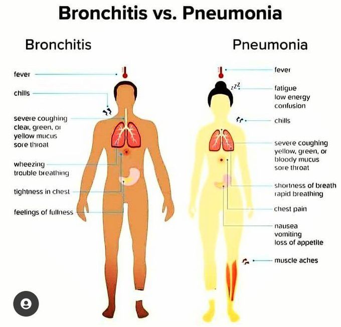 Bronchitis vs pneumonia