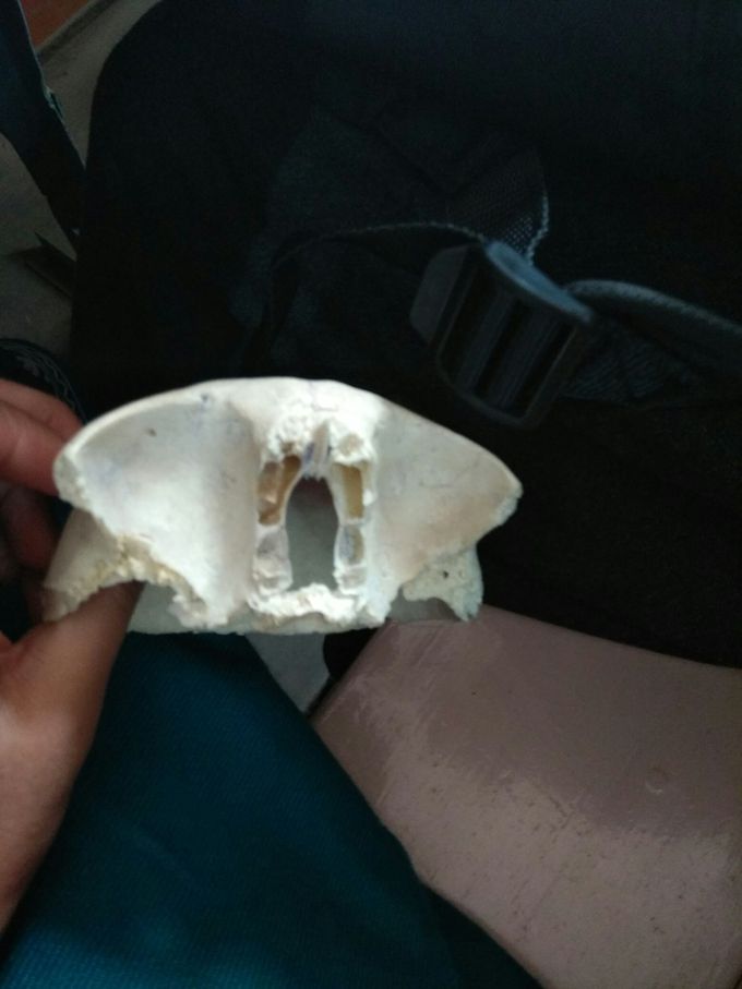 Frontal bone