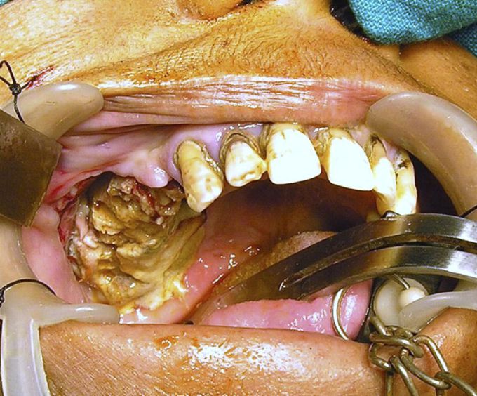Maxillary Necrosis subsequent to tooth extraction!!