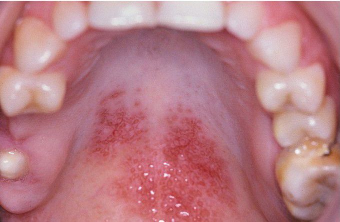 Chronic Cutaneous Lupus Erythematosus (CCLE).