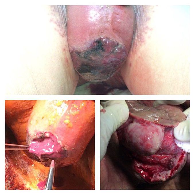 Fournier gangrene...after debridement progression...7th day 