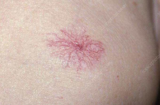 What causes spider nevus?