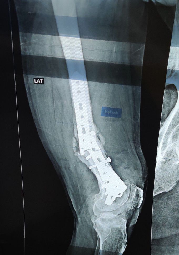 Broken Intramedullary Nail Femur