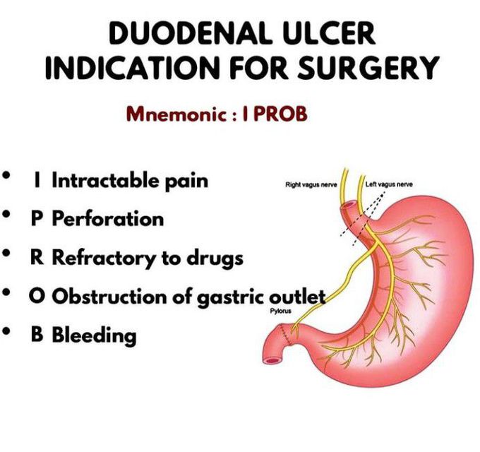 Duodenal Ulcer Surgery