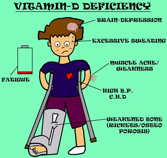 Vitamin-D deficiency