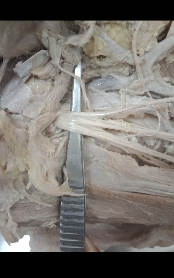 Variation in origin of Sephanous nerve