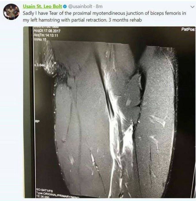 Usain Bolt's MRI from his injury in last career race!