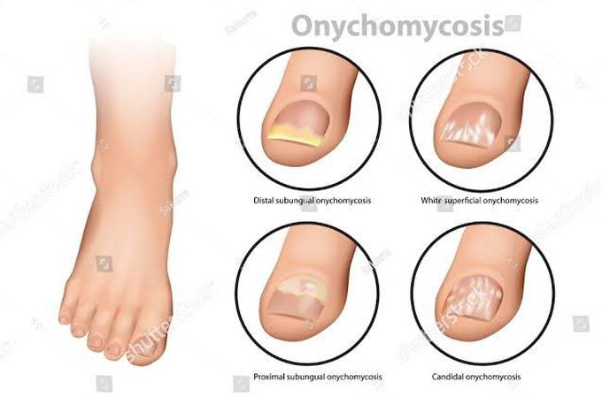 Tinea unguium, also known as onychomycosis. This patient presented with