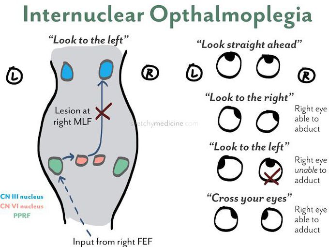RIGHT MLF SYNDROME