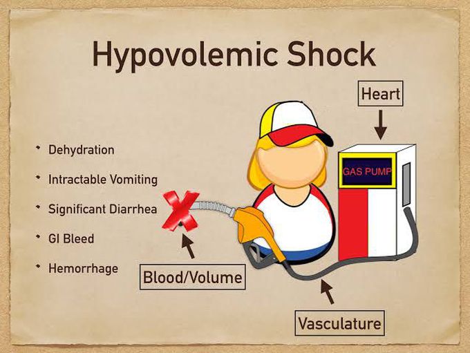 Hypovolemic Shock
