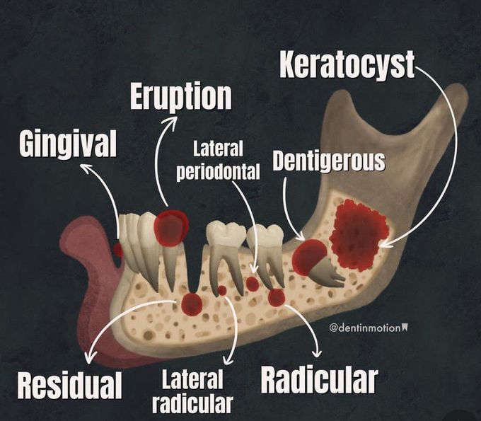 Odontogenic Cyst