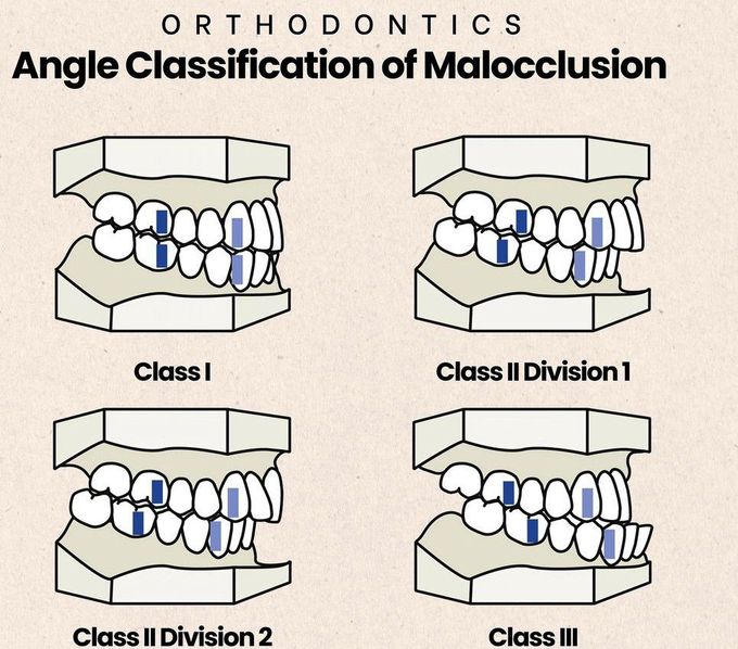 Angles Classification of Malocclusion