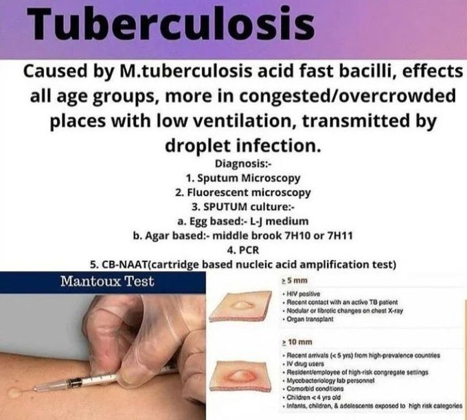 Tuberculosis