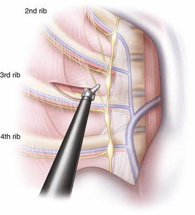 Thoracoscopic sympathectomy