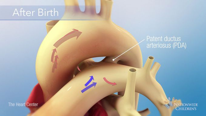 Patent Ductus Arteriosus (PDA) Occlusion
 Procedure made easy