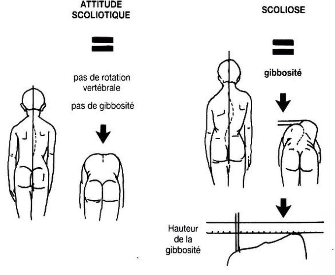 Déformation rachis