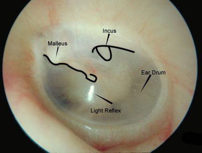 Left tympanic membrane