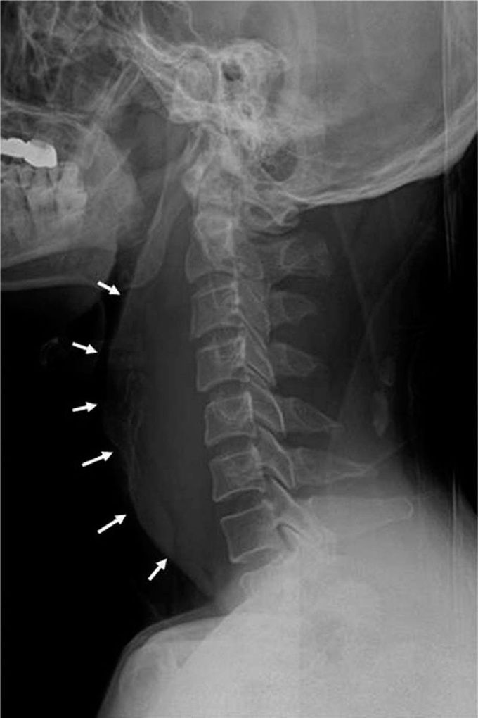 The Hidden Trauma: Retropharyngeal Hematoma Secondary to Hyperextension of Neck