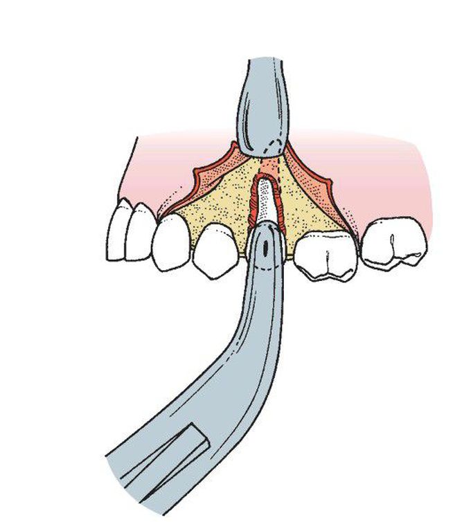 Traction of root